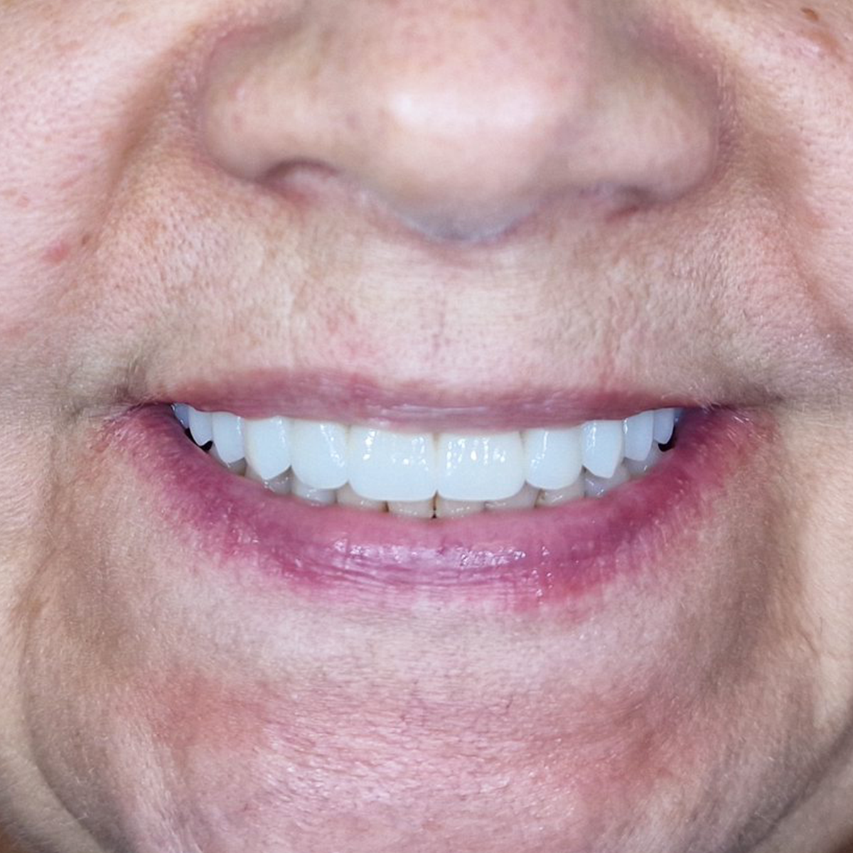 All-on-4 šypsena - Neringa