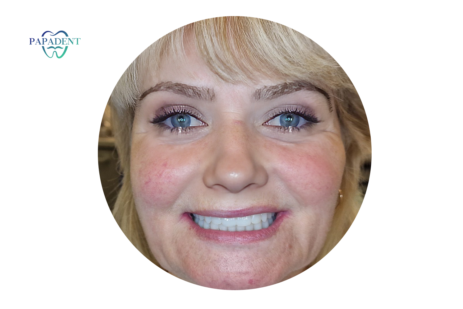 Софии была проведена имплантация All-on-4